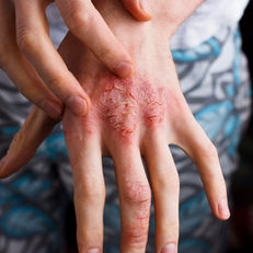 Avaderma Skin & Hair Clinic - Contact Dermatitis